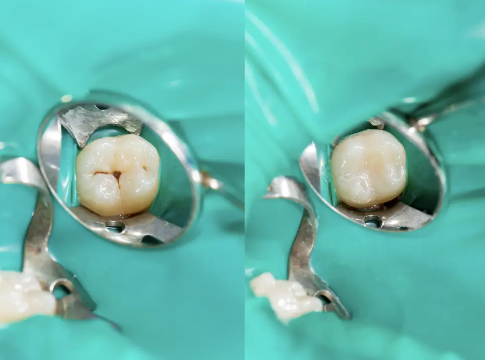 Empast Dental: Què És, Procediment I Cures Empast Dental: Què És, Procediment I Cures