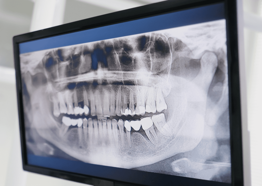 Radiografia Dental Digital A Vilanova I La Geltrú Odontologia Preventiva
