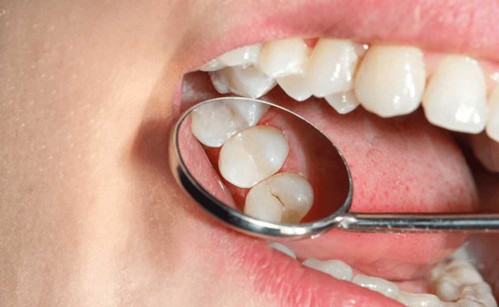 caries