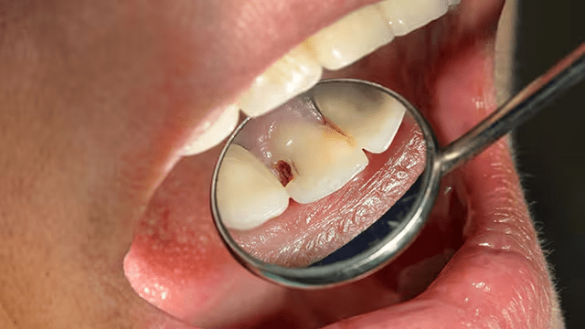 Tips for Preventing Cavities