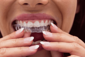 Invisalign A Vilanova